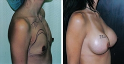 Breast Augmentation Patient Before & After Photo 1