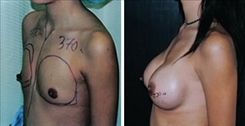 Breast Augmentation Patient Before & After Photo 1