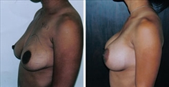 Breast Augmentation Patient Before & After Photo 1