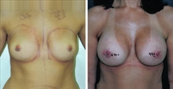 Breast Augmentation Patient Before & After Photo 1