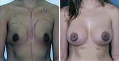 Breast Augmentation Patient Before & After Photo 1