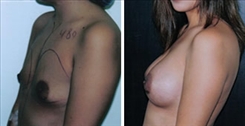 Breast Augmentation Patient Before & After Photo 1