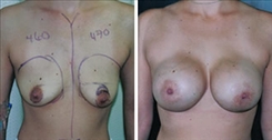 Breast Augmentation Patient Before & After Photo 1