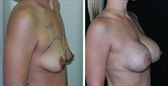 Breast Augmentation Patient Before & After Photo 1