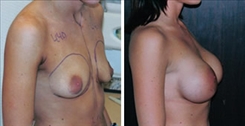 Breast Augmentation Patient Before & After Photo 1