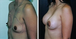 Breast Augmentation Patient Before & After Photo 1