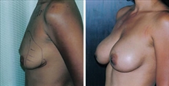 Breast Augmentation Patient Before & After Photo 1