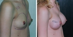 Breast Augmentation Patient Before & After Photo 1