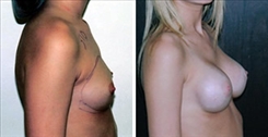 Breast Augmentation Patient Before & After Photo 1