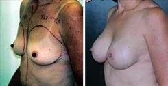 Breast Augmentation Patient Before & After Photo 1