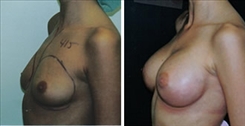 Breast Augmentation Patient Before & After Photo 1