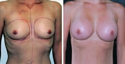 Breast Augmentation Patient Before & After Photo 1