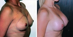 Breast Augmentation Patient Before & After Photo 1