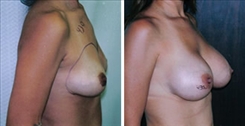 Breast Augmentation Patient Before & After Photo 1