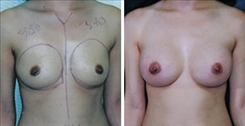 Breast Augmentation Patient Before & After Photo 1