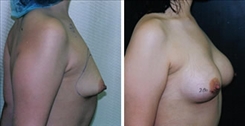 Breast Augmentation Patient Before & After Photo 1