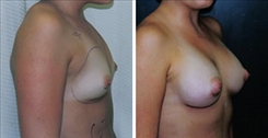 Breast Augmentation Patient Before & After Photo 1