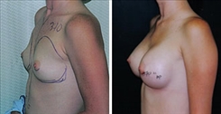 Breast Augmentation Patient Before & After Photo 1