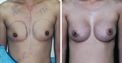 Breast Augmentation Patient Before & After Photo 1