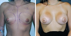 Breast Augmentation Patient Before & After Photo 1