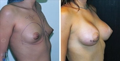 Breast Augmentation Patient Before & After Photo 1