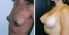 Breast Augmentation Patient Before & After Photo 1