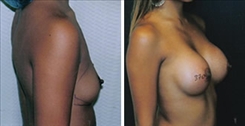 Breast Augmentation Patient Before & After Photo 1