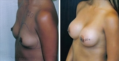 Breast Augmentation Patient Before & After Photo 1