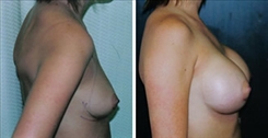 Breast Augmentation Patient Before & After Photo 1