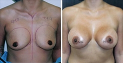 Breast Augmentation Patient Before & After Photo 1