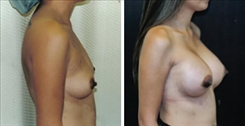 Breast Augmentation Patient Before & After Photo 1