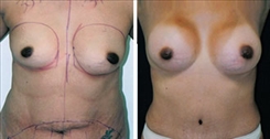 Breast Augmentation Patient Before & After Photo 1