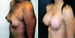 Breast Augmentation Patient Before & After Photo 1