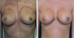 Breast Augmentation Patient Before & After Photo 1