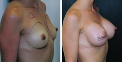 Breast Augmentation Patient Before & After Photo 1