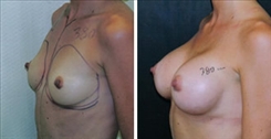 Breast Augmentation Patient Before & After Photo 1