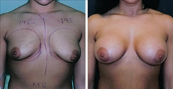 Breast Augmentation Patient Before & After Photo 1