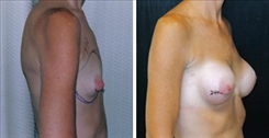 Breast Augmentation Patient Before & After Photo 1