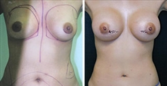 Breast Augmentation Patient Before & After Photo 1