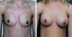 Breast Augmentation Patient Before & After Photo 1