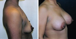 Breast Augmentation Patient Before & After Photo 1