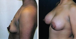 Breast Augmentation Patient Before & After Photo 1