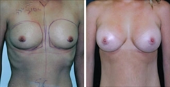 Breast Augmentation Patient Before & After Photo 1