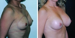 Breast Augmentation Patient Before & After Photo 1