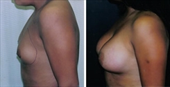 Breast Augmentation Patient Before & After Photo 1