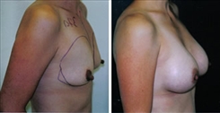 Breast Augmentation Patient Before & After Photo 1