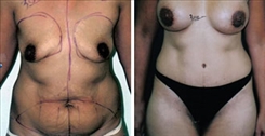 Breast Augmentation Patient Before & After Photo 1