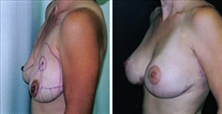 Breast Augmentation Patient Before & After Photo 1