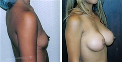 Breast Augmentation Patient Before & After Photo 1