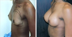 Breast Augmentation Patient Before & After Photo 1